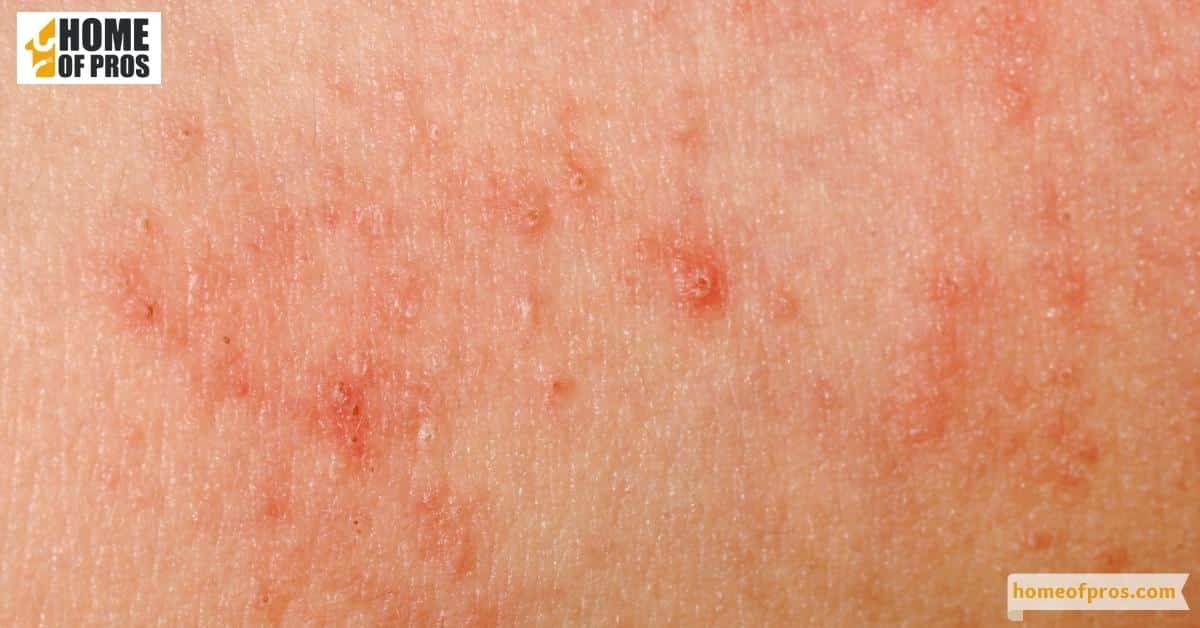Possible Allergic Reactions